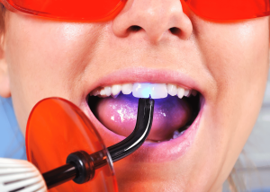 Dos and Don’ts After Tooth Filling